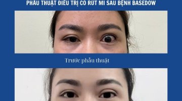 PHẪU THUẬT ĐIỀU TRỊ CO RÚT MI SAU BỆNH BASEDOW